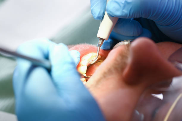 Best Emergency Wisdom Teeth Removal in Vandalia, OH